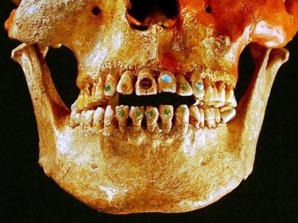 Primeros dentistas: Dentadura salpicada de piedras preciosas