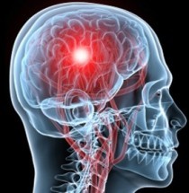 Accidentes cerebrovasculares: Causas, Tipos y Tratamiento